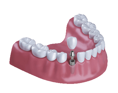 3D-Illustration Gebiss mit Implantat -Zahnzusatzversicherung Münchener Verein